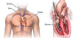Катетеризация сердечной мышцы - один из способов определения легочного давления
