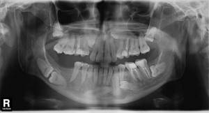 рентген при отсутствии зубов