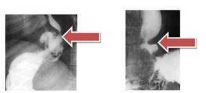 рентгенограмма грудной клетки больного с диафрагмальной грыжей