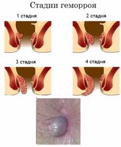 Женский геморрой: симптомы (фото начальной стадии у женщин), причины и лечение в домашних условиях
